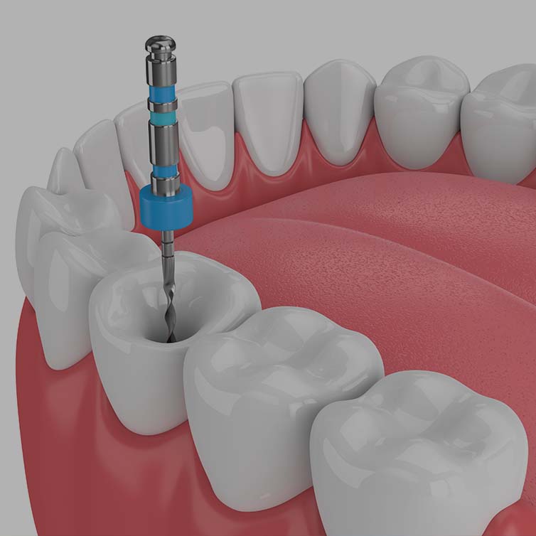 Treatment - Huntingdon Smiles