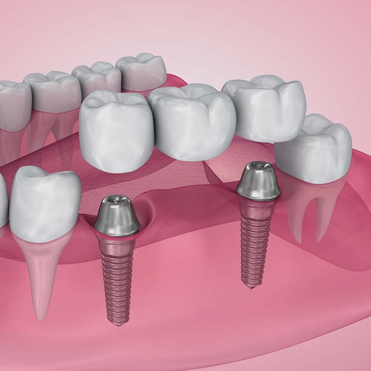 Treatment - Huntingdon Smiles