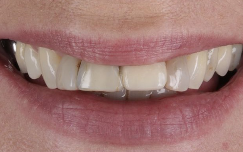 Before - Huntingdon Smiles