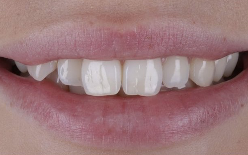 Before - Huntingdon Smiles
